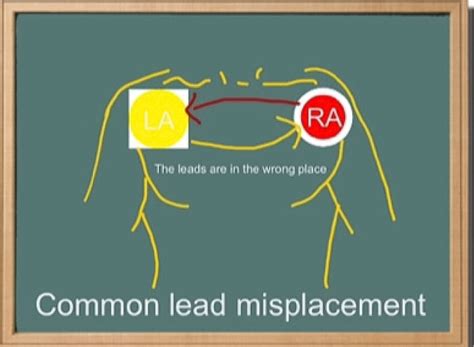 ECG Educator Blog : Dextrocardia