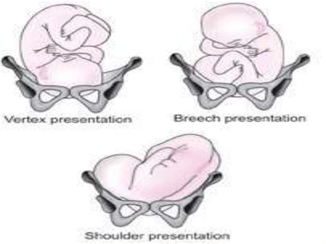 Obstructed Labour ppt