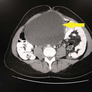 CT scan of the mesenteric cyst (arrow). | Download Scientific Diagram