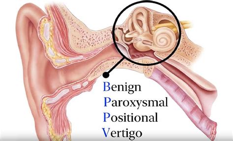 Patient Education Series: Benign Paroxysmal Positional Vertigo