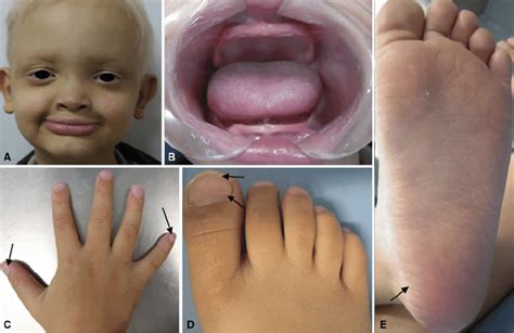 Ectodermal Dysplasia Teeth