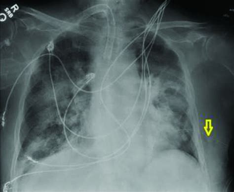 Loculated pneumothorax with a deep sulcus sign | Hernandez | The Southwest Respiratory and ...
