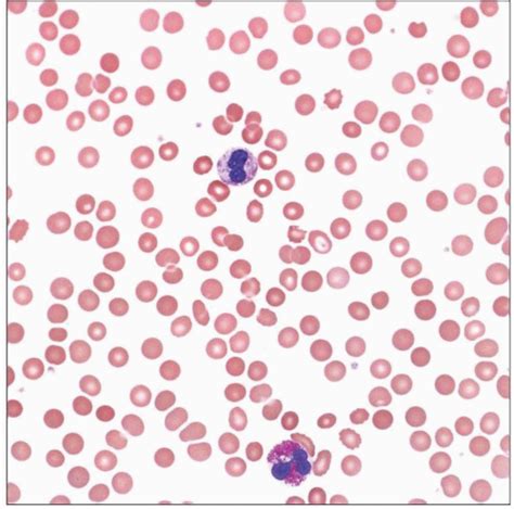 Anemia of Chronic Disease | Basicmedical Key