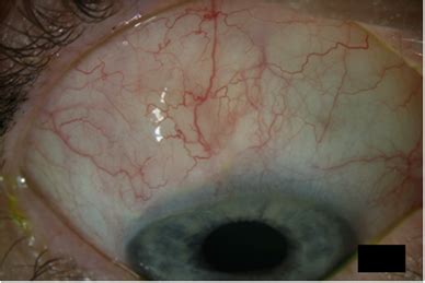 Filtering bleb of an ologen trabeculectomy bleb 12 months after... | Download Scientific Diagram