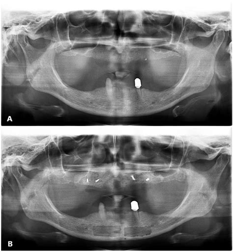 A. Preoperative orthopantomography, B. Orthopantomography after bone ...