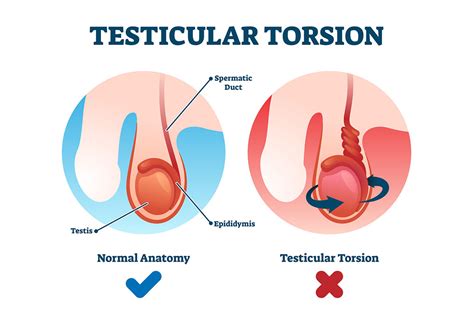 Testicular Torsion Treatment