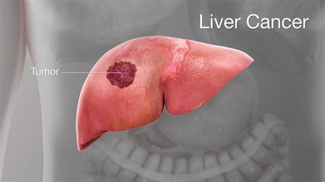 Liver cancer: Symptoms, Causes, and Treatment - Scientific Animations