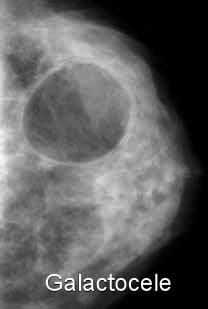 Galactocele of the breast. Common benign - Moose and Doc