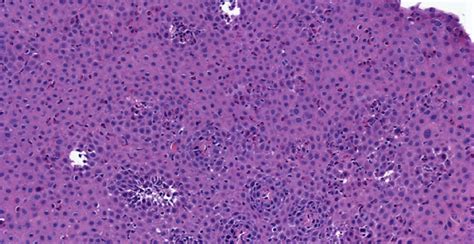 HE staining from the same patient showing many eosinophils, dilated... | Download Scientific Diagram