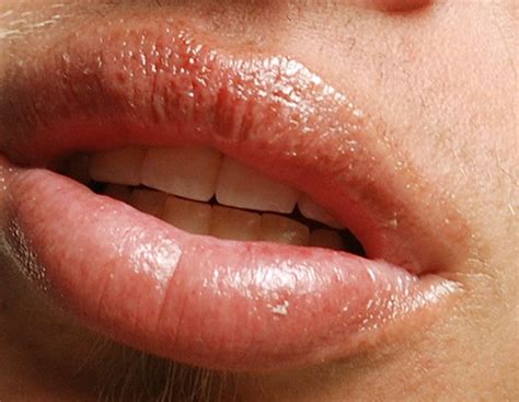 Sunburned Lips - Pictures, Symptoms, Treatment, Causes