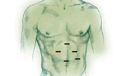 Laparoscopic Nissen Fundoplication | Memorial Hermann