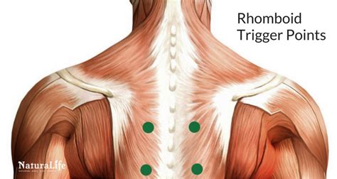 Melt Away Headaches With Trigger Point Therapy - Naturalife