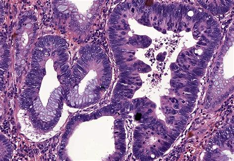 Tubular Adenoma Histology