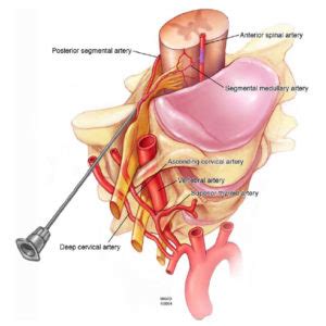 Transforaminal Epidural Steroid Injections - Pain management clinics in Las Vegas | Nevada ...