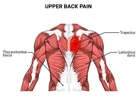 Upper Back Pain Doctors NJ & NYC | Back Pain & Injury Treatments