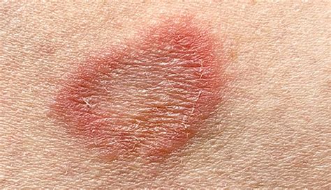 Ringworm (Tinea Corporis): What It Looks Like, Causes & Treatment