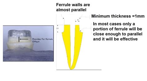 What is Ferrule in Dentistry? | News | Dentagama