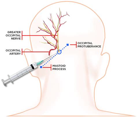 Occipital Nerve Block | Aptiva Health