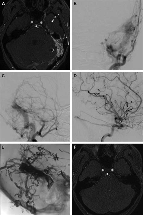 Dural Arteriovenous Fistulae | Radiology Key