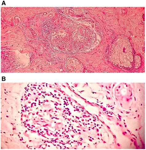 Facial Tuberculoid Leprosy in: The American Journal of Tropical Medicine and Hygiene Volume 106 ...