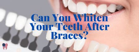 Teeth Whitening After Braces - How To ? Should I?