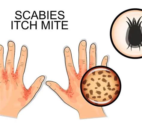 Kill Scabies Mites