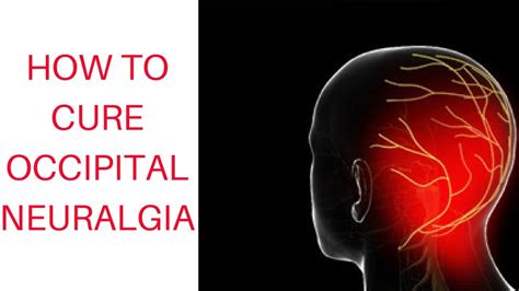 How To Cure Occipital Neuralgia - YouTube