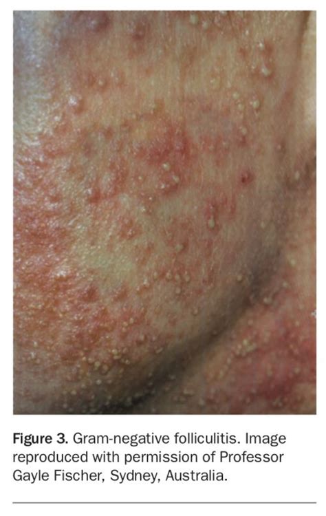 Folliculitis: diagnosis and management of subtypes | Medicine Today