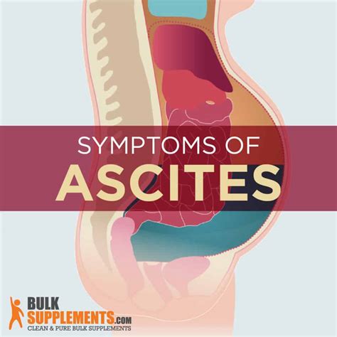 Ascites: Symptoms, Causes & Treatment