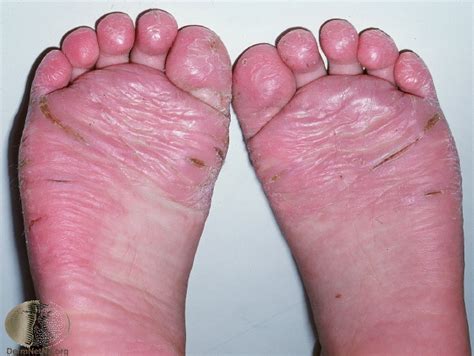 juvenile plantar dermatosis - pictures, photos