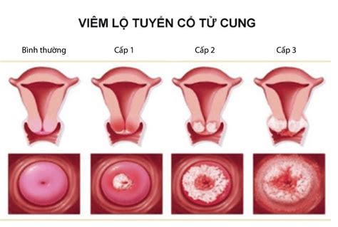 Is it necessary to treat cervical ectropion during pregnancy? | Vinmec