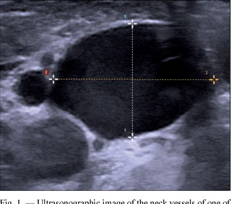 Figure 3 from Internal jugular vein location and anatomy on ultrasound ...