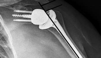 Why Do Acromial Fractures Occur After Reverse Shoulder Arthroplasty ...