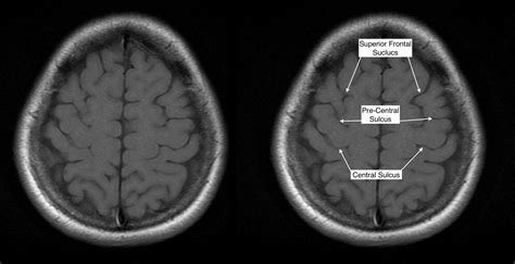 Radiological Anatomy: Central Sulcus - Stepwards