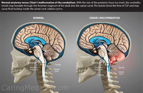 Cerebellar Tonsils Mri