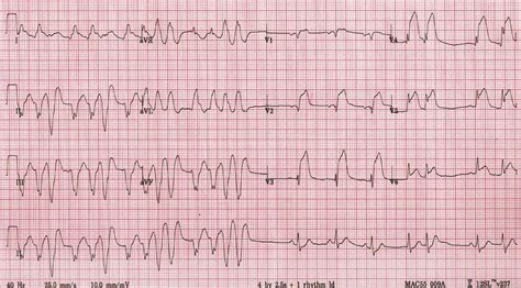 UNDERSTAND WHAT IS HEART ATTACK. CAUSES, SIGNS AND SYMPTOMS AND COMPLICATIONS OF HEART ATTACK ...