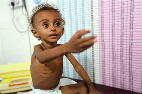 UNICEF: Millions of Yemeni children in immediate risk of starvation ...