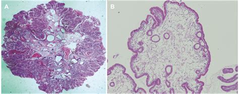 (A) microscopic feature of an adenomatous polyp. The polyp was composed ...