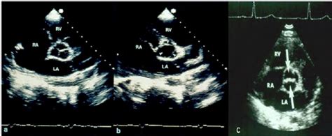 Parasternal Short Axis View Aortic Valve