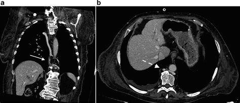 -In the venous CT phase, there's the evidence of the hemiazygos vein... | Download Scientific ...