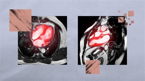 Heart MRI scans: Who may need one, what to expect, and more