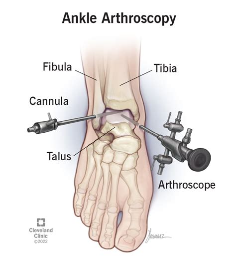 Ankle Arthroscopy: Procedure, Surgery & Recovery