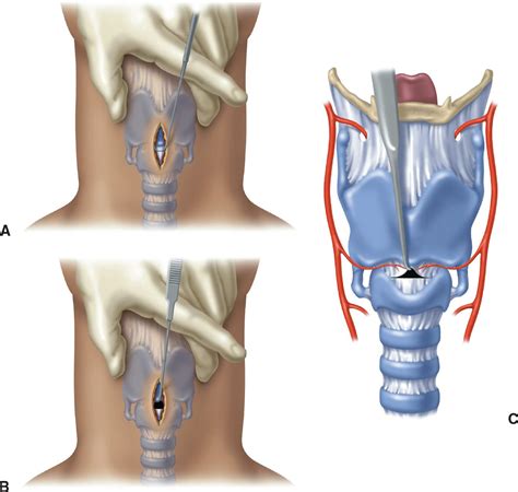 Cricothyroidotomy Anatomy