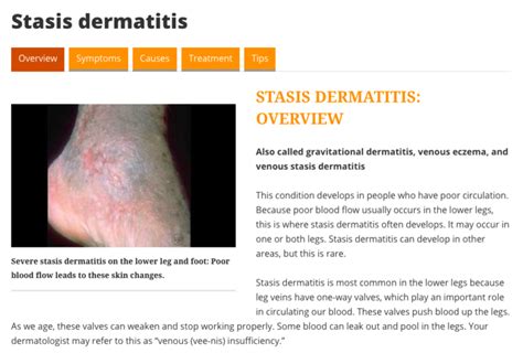 About Stasis Dermatitis - Dermatitis Academy