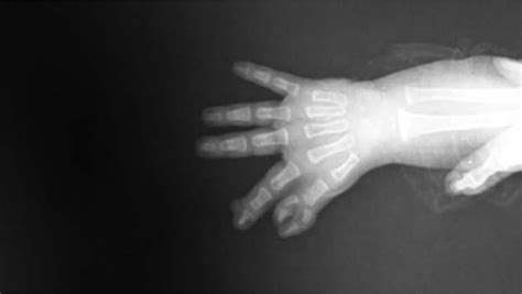 The picture X-rays of right hand that shows the deformities... | Download Scientific Diagram