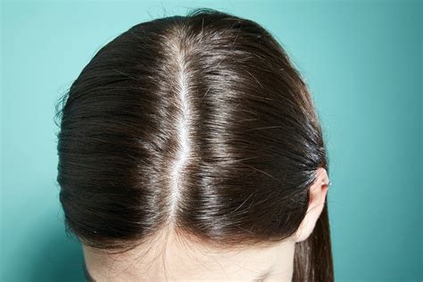 How To Get Rid Of Dandruff: Causes, Tips, And Treatment!