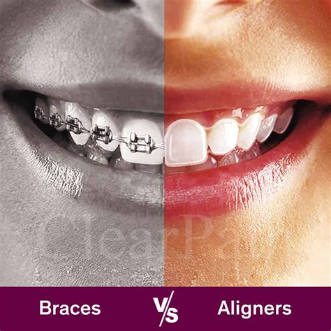 Clear Braces Costs Best Brands, Pros Cons, 57% OFF