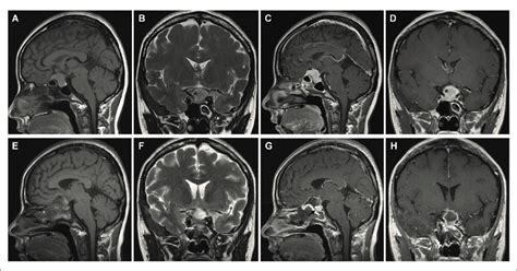 Tuberculum sellae meningioma (WHO grade I). (A-D) Preoperative MRI ...