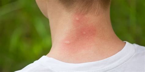 Mosquito Bite Allergy Symptoms - Mosquito Bite Reaction Meaning