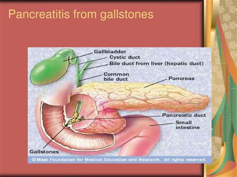 PPT - PANCREATITIS PowerPoint Presentation, free download - ID:2961208